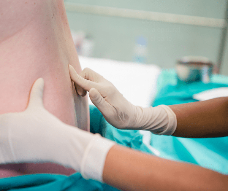 Desventajas de ponerse la epidural en el parto